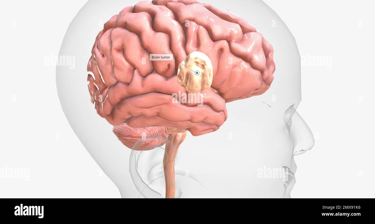 Benign brain mri hi-res stock photography and images - Alamy