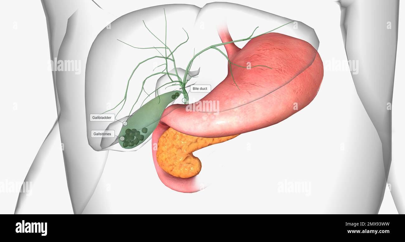 Small Gallbladder Gallstones in the gallbladder hi-res stock photography and images - Alamy