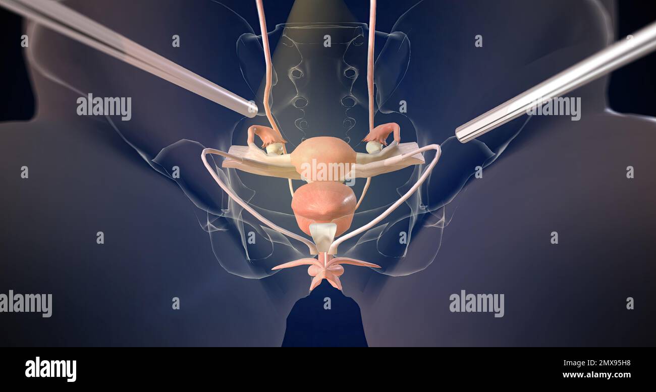 Hysterectomy procedure hi-res stock photography and images - Alamy