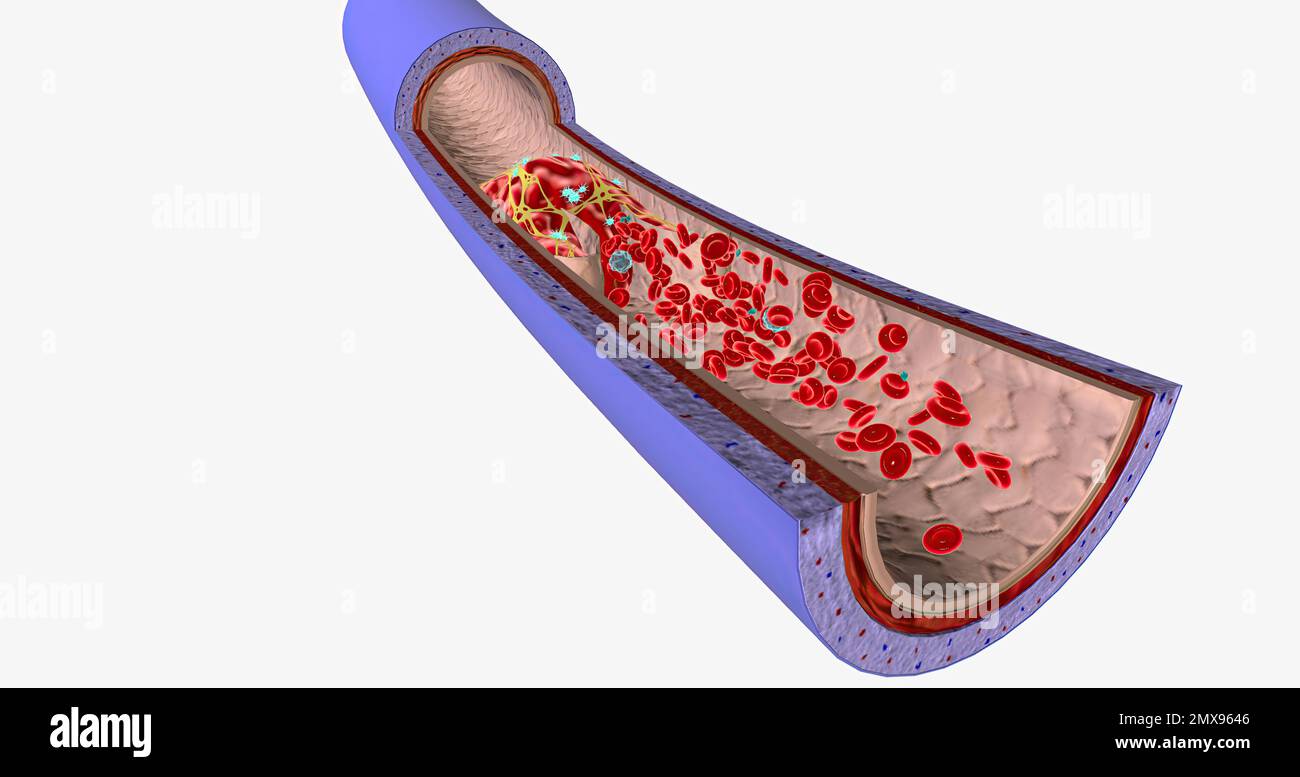 A blood clot in a vein, or venous thrombus, is the clumping of blood in
