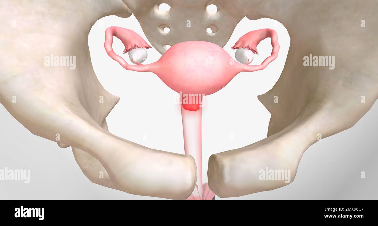 Chlamydia is a sexually transmitted infection caused by Chlamydia