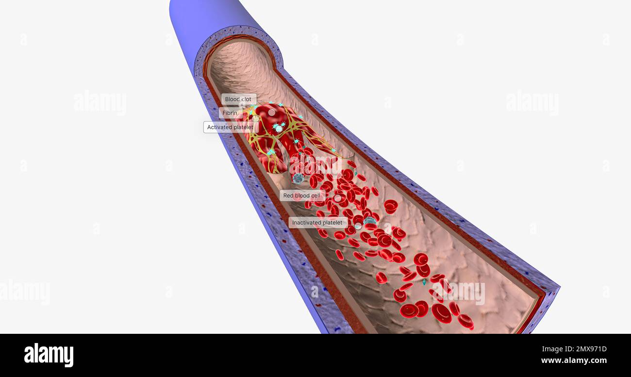 A blood clot in a vein, or venous thrombus, is the clumping of blood in