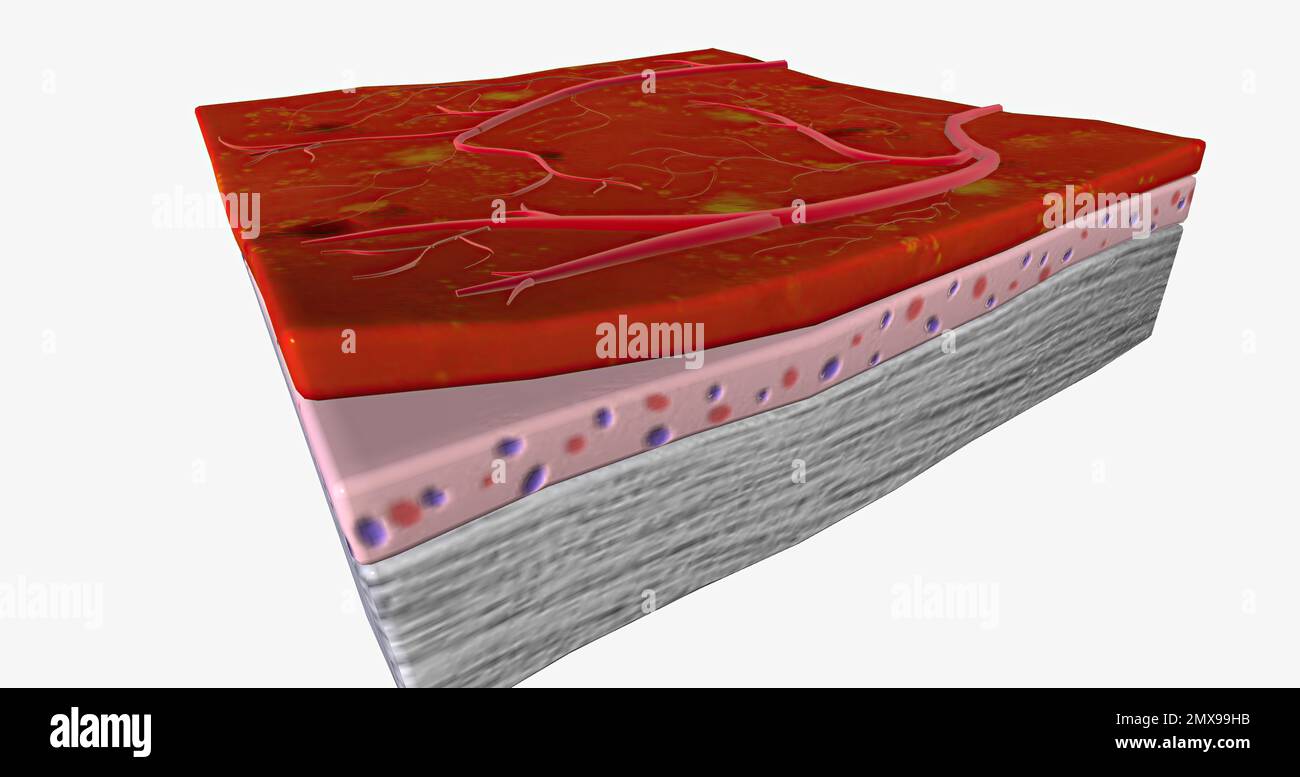 The abnormal blood vessels leak easily, causing the eye to fill with