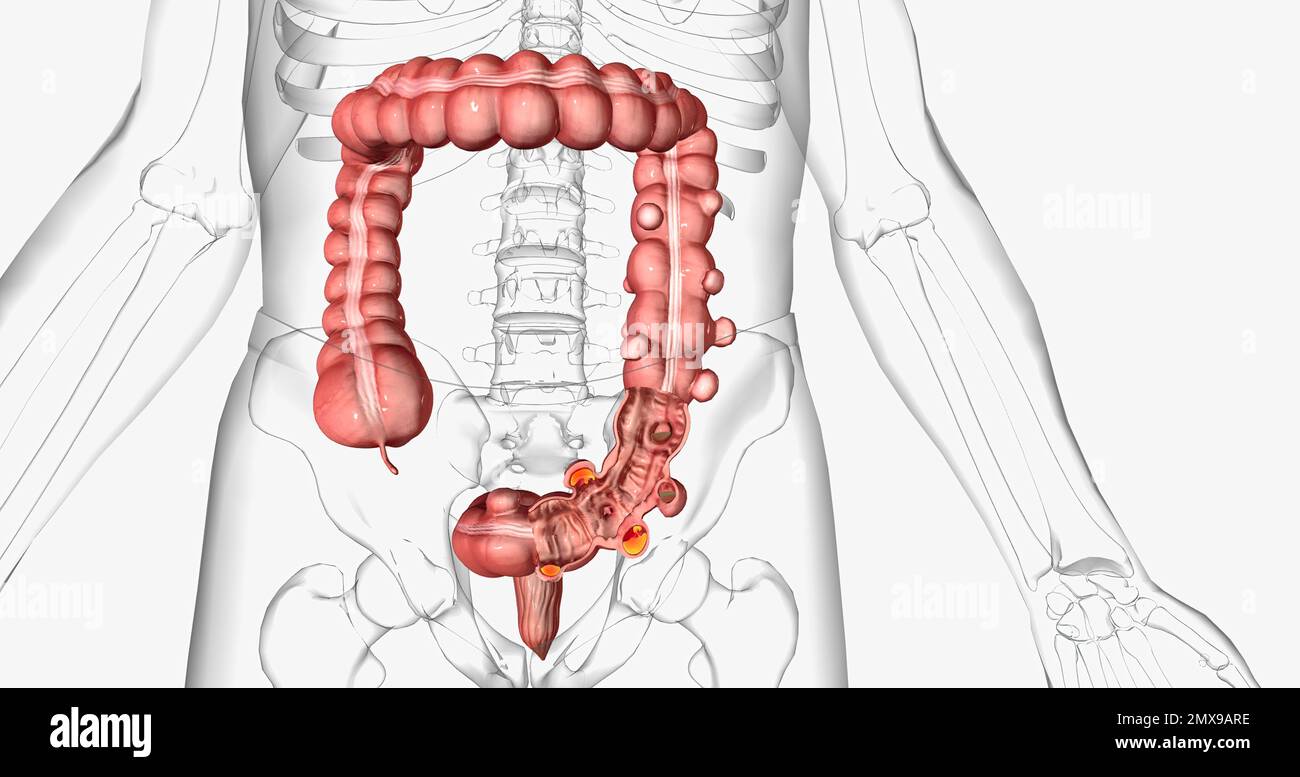 Diverticulitis surgery hi-res stock photography and images - Alamy