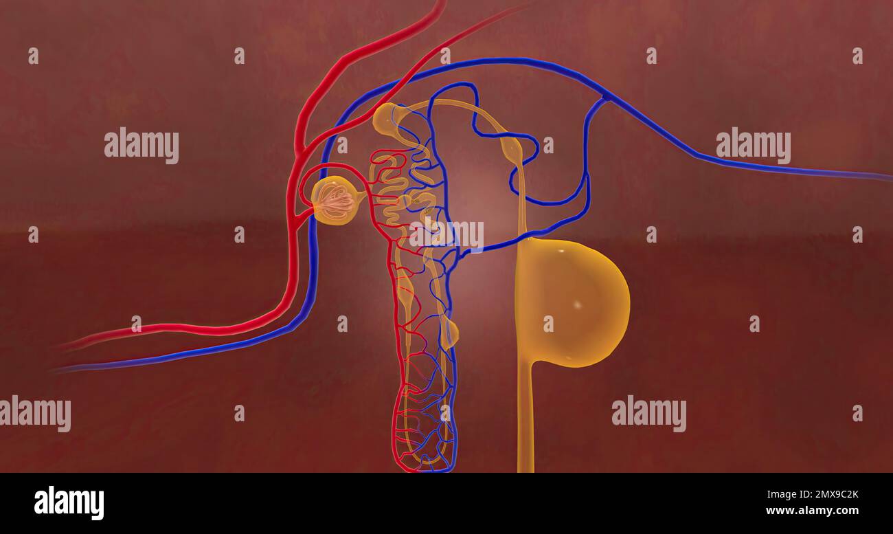 The cysts caused by PKD block the blood vessels and urine producing