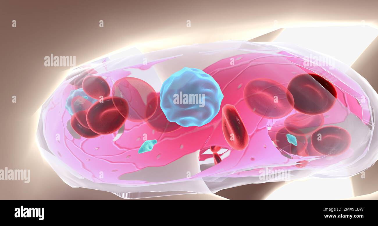 Aplastic anemia is a blood disease characterized by the reduced