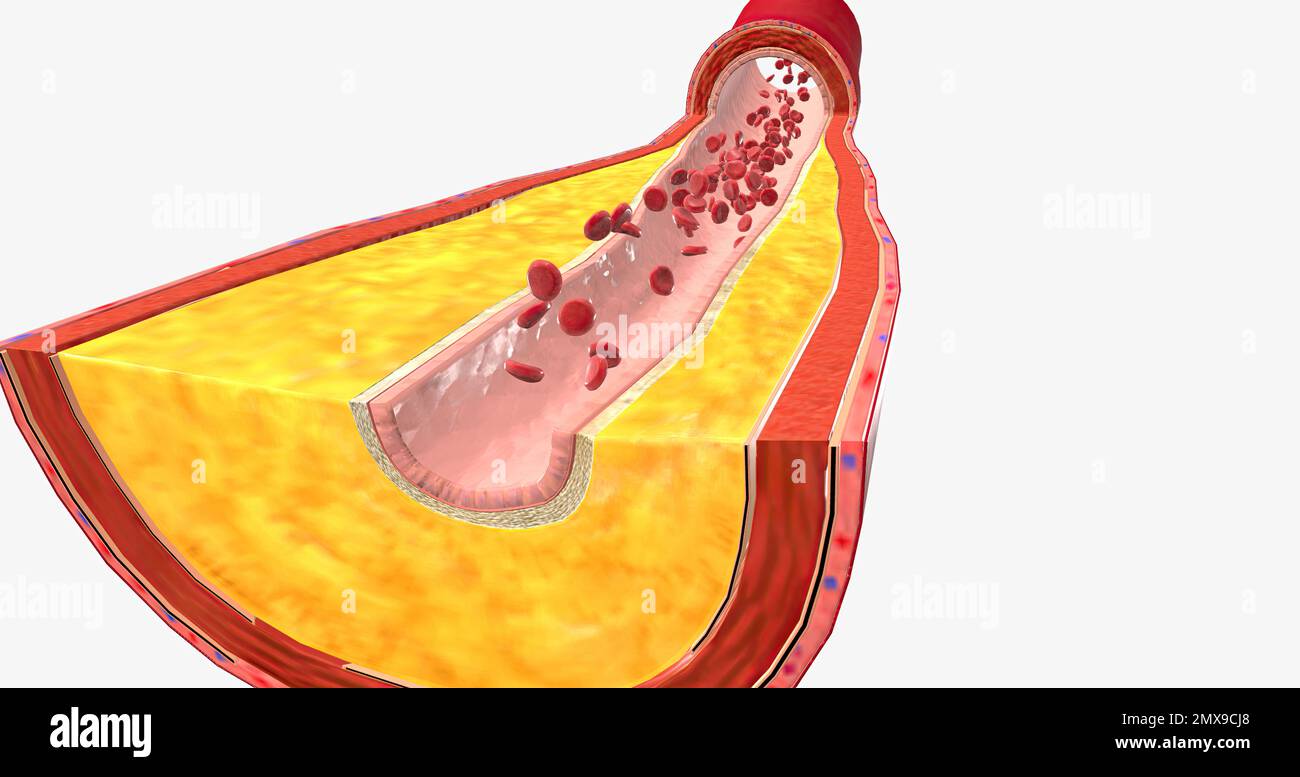 Healthy and atherosclerotic arteries hires stock photography and