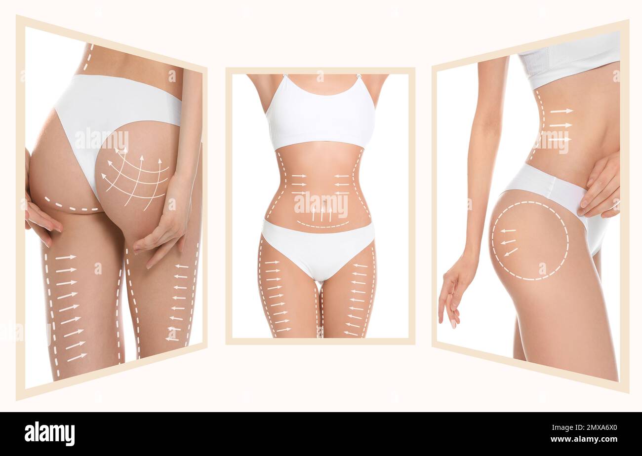 Photos of young woman with marks on body against white background