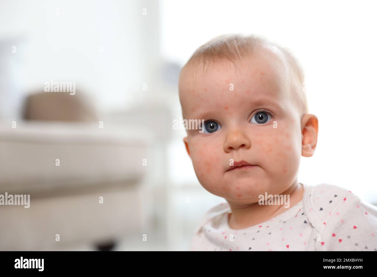 Little child with red rash indoors, space for text. Baby allergies