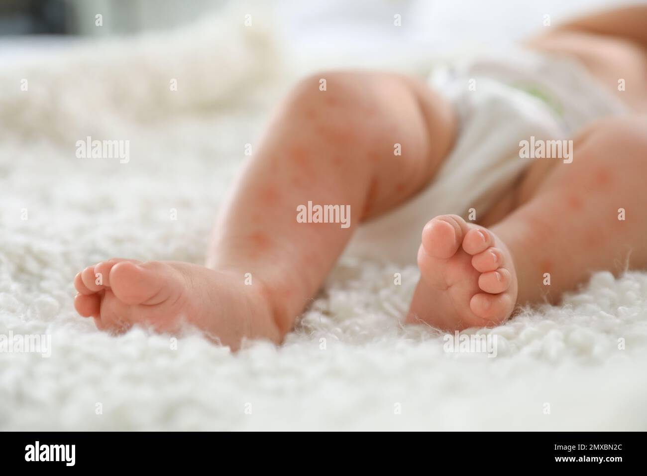 Little child with red rash on bed, closeup. Baby allergies Stock Photo