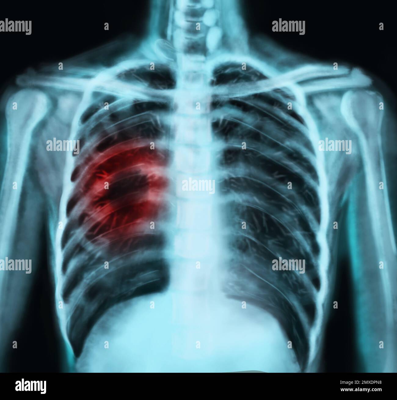 Xray of patient with lung cancer. Illustration Stock Photo Alamy