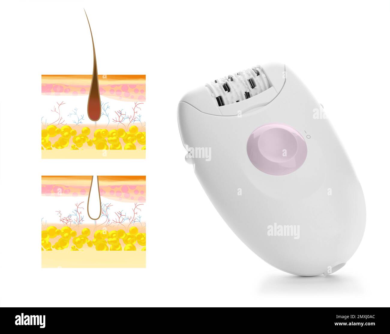 Epilation procedure. Modern appliance and illustrations of hair