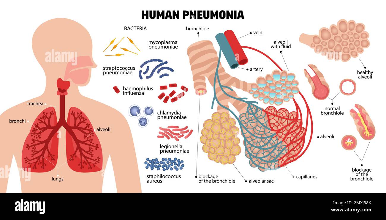 Human pneumonia composition with icons of infectious bacteria human ...
