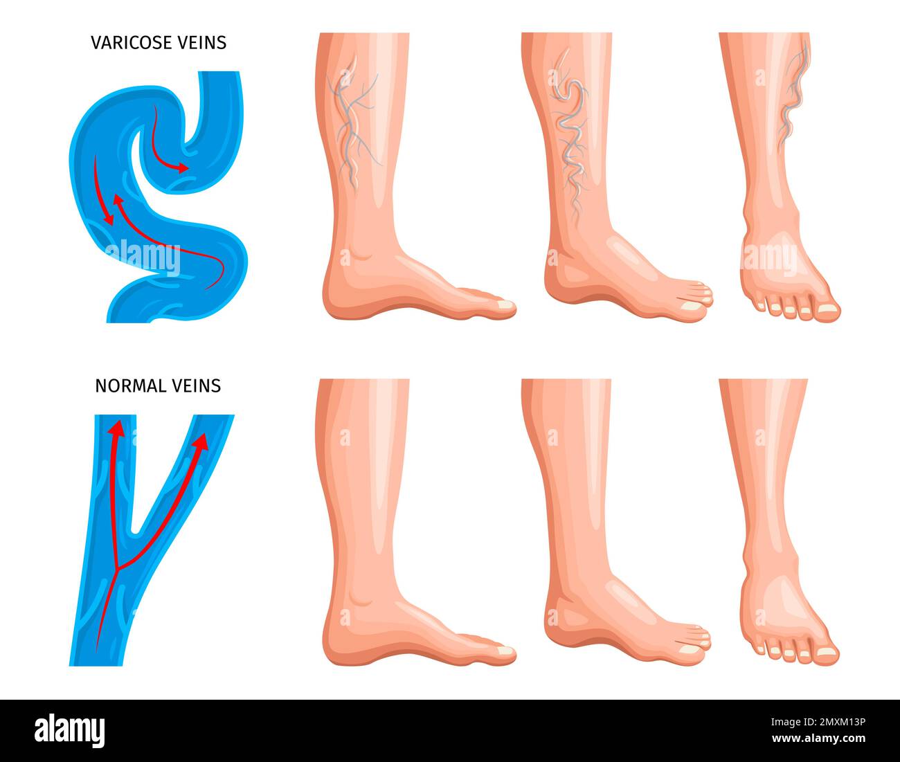 Varicose Veins Anatomy Realistic Set With Magnifying Scheme Of Blood 