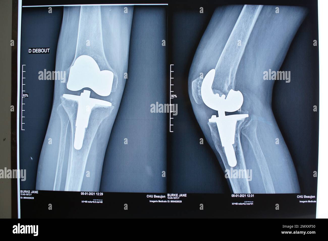 Total knee replacement xray Zimmer NexGen arthroplasty, female