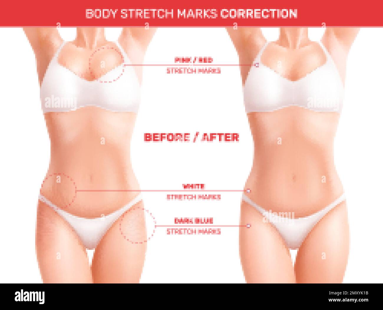 Female woman body stretch marks realistic composition with editable text pointers and before after correction views vector illustration Stock Vector