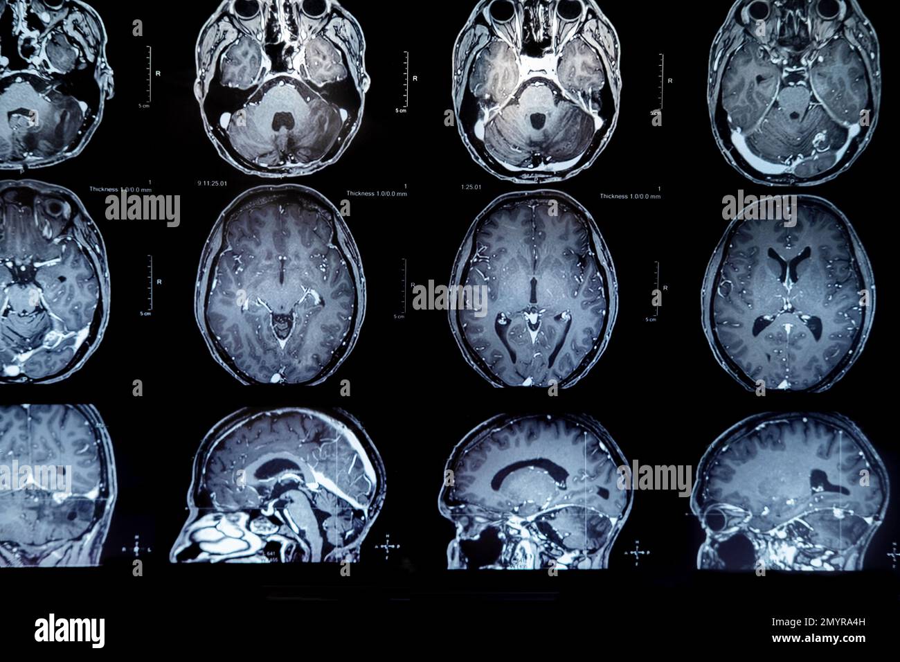 mri with brain tumor. Magnetic resonance imaging. Stock Photo