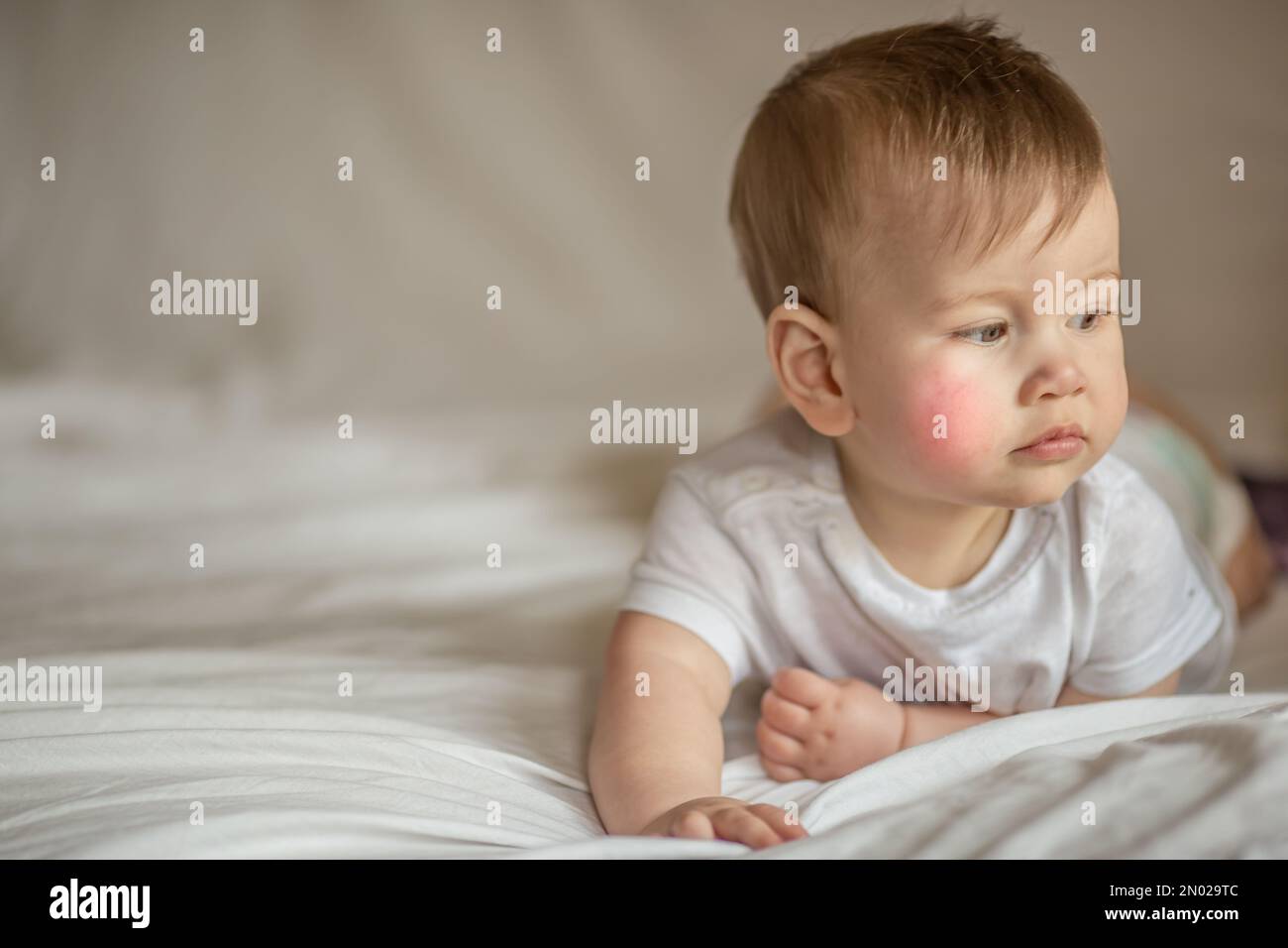 Atopic dermatitis eczema in baby.Condition that causes the skin to