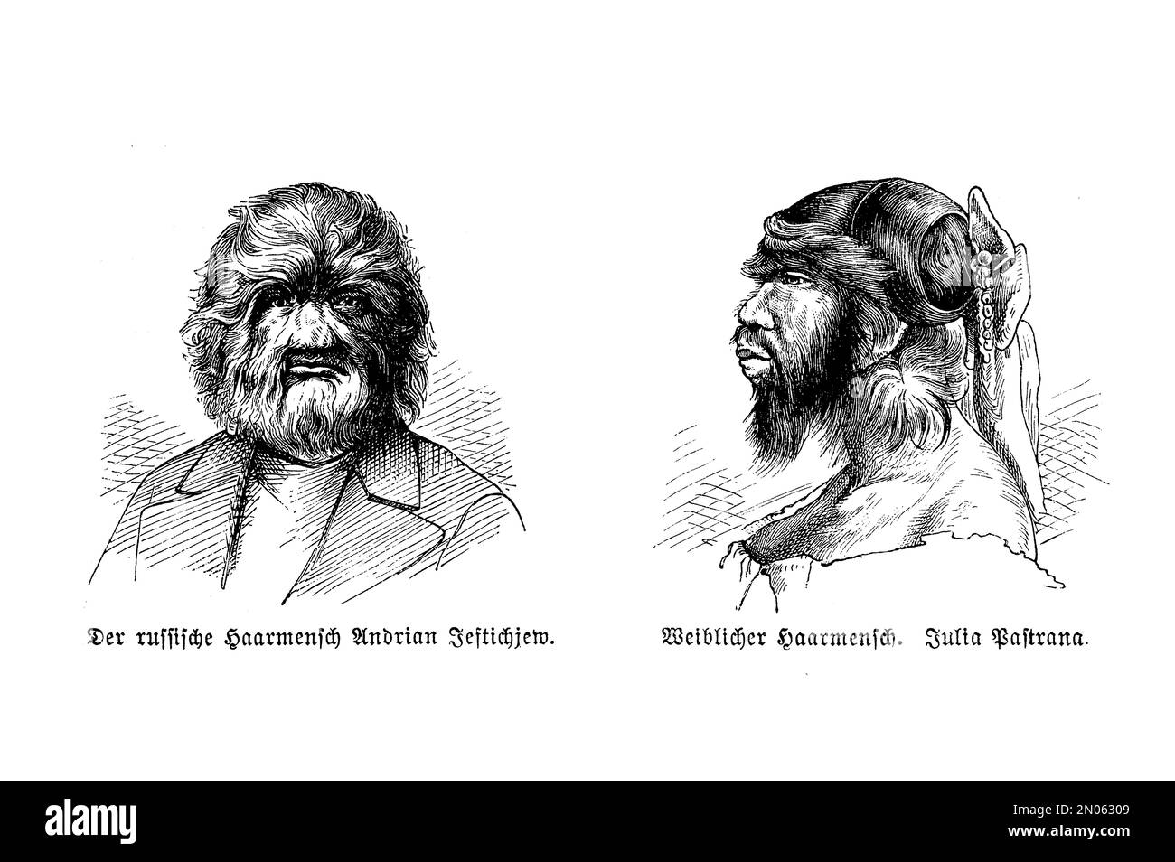 Vintage illustration of  human  male and female heads with trichosis, hairiness disease Stock Photo