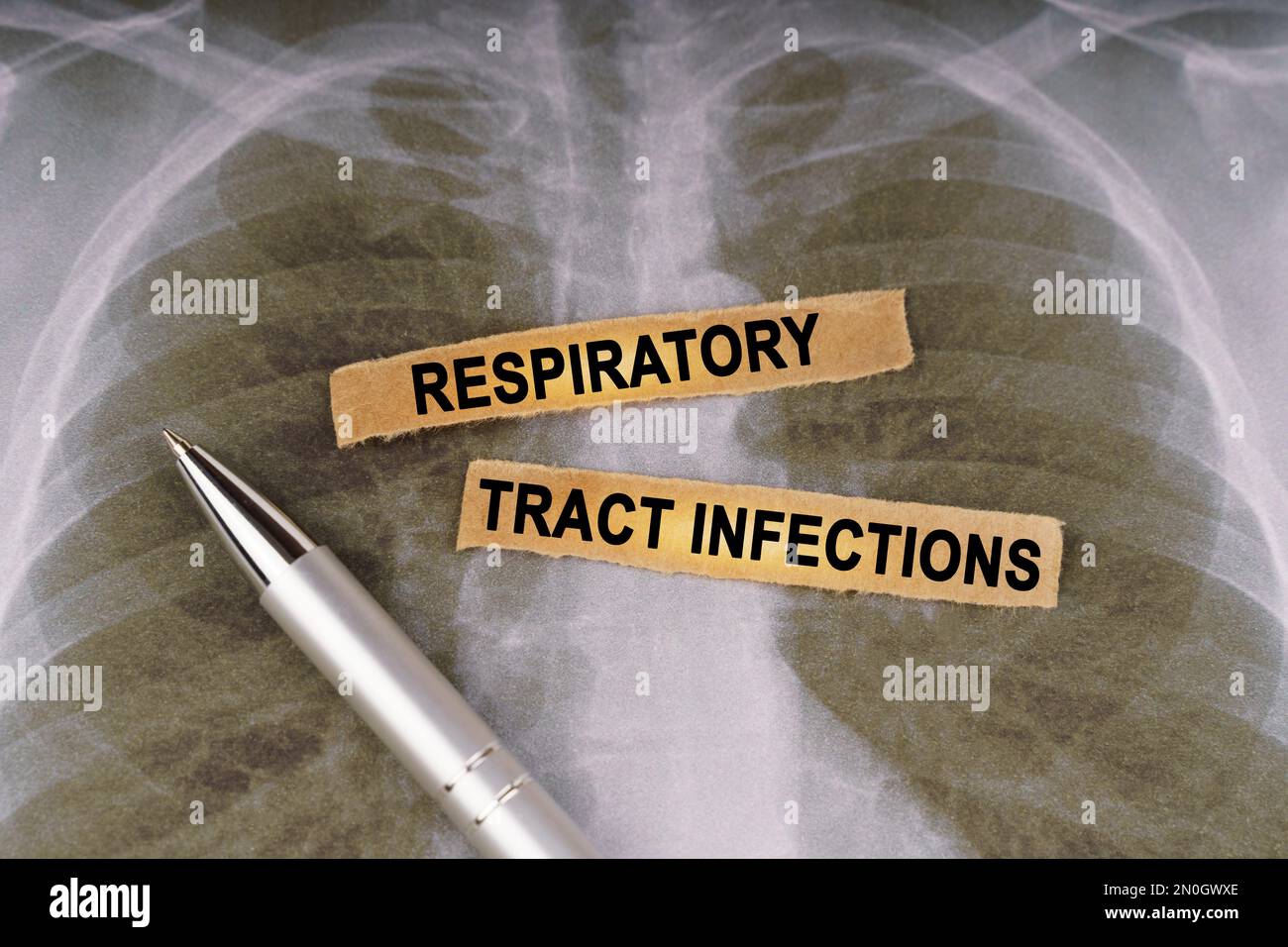 Medical concept. On a human chest x-ray, a pen and strips of paper labeled - Respiratory tract infections Stock Photo