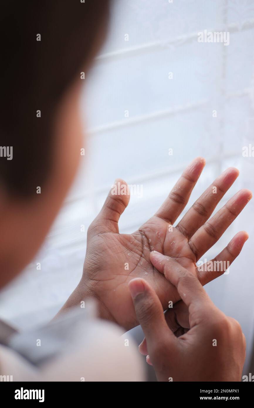 close up of Dry cracked skin of a men's hand  Stock Photo