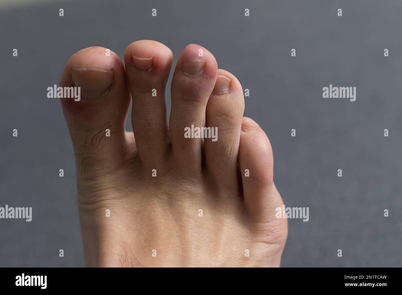 The foot, five toes, of a caucasian male with a damaged toe. Underneath