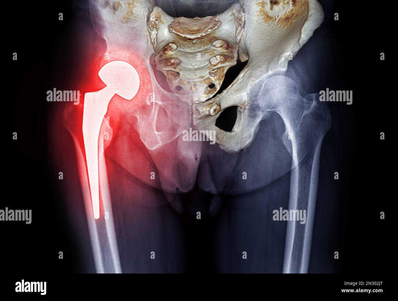 x-ray Both hip  ap view showing Right hip replacement or hip prosthesis made from titanium with fusion 3D rendering . Stock Photo