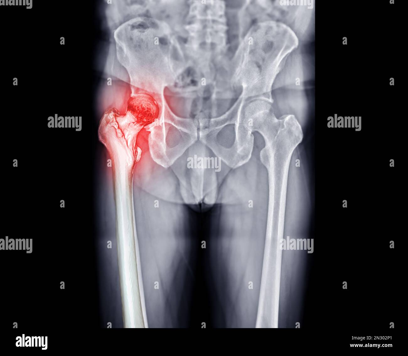 x-ray Both hip  ap view showing Right hip replacement or hip prosthesis made from titanium . Stock Photo