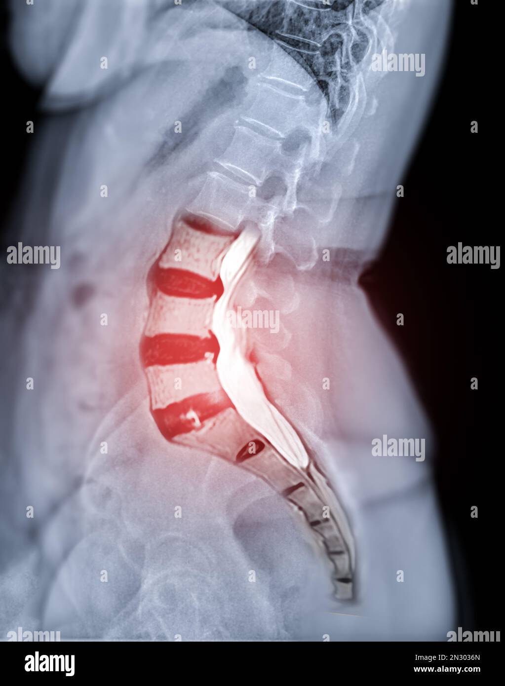 X-ray image of lumbar Spine  or L-s spine lateral view with MRI  l-s spine  for diagnosis lower back pain. Stock Photo