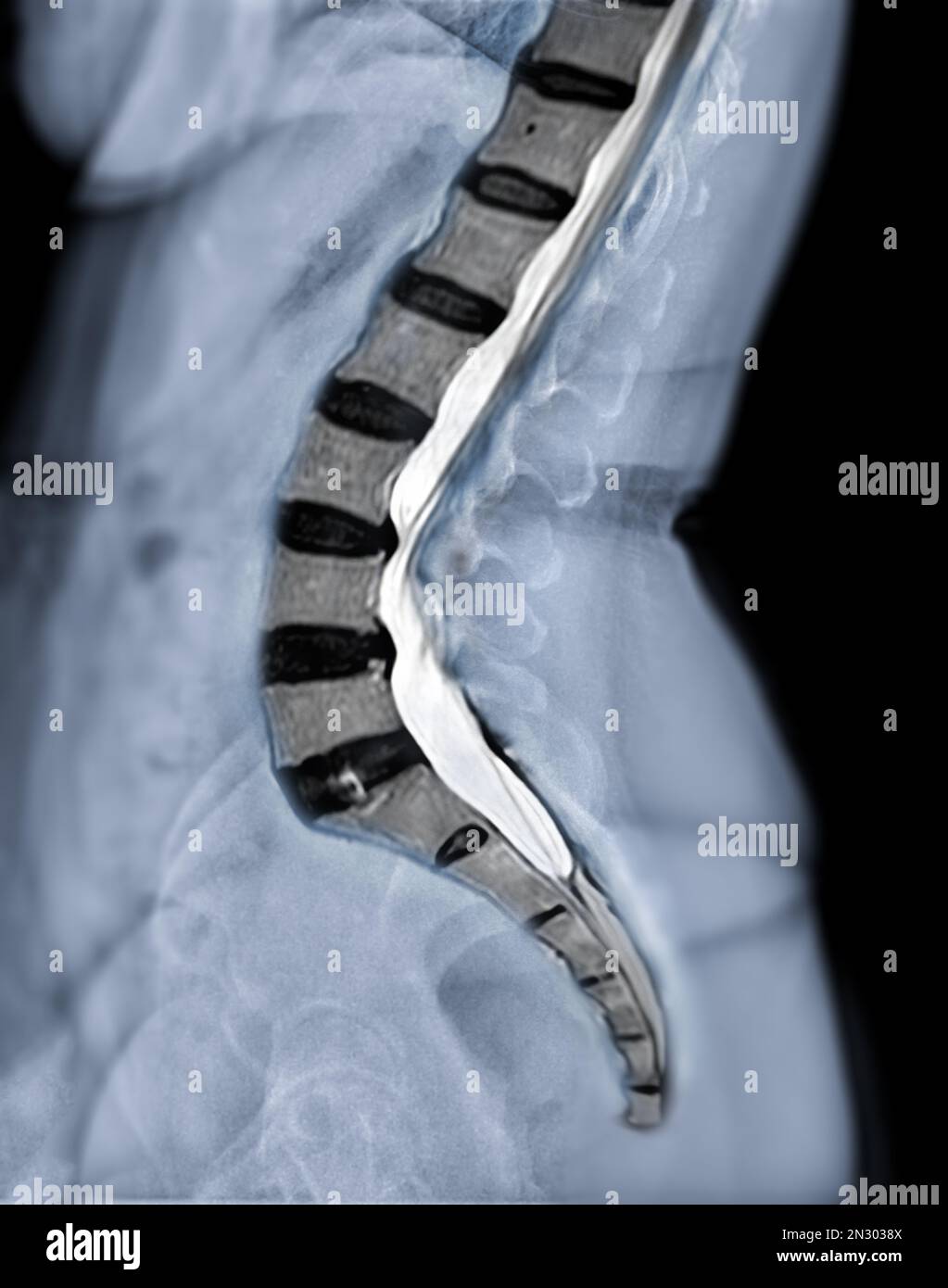 https://c8.alamy.com/comp/2N3038X/x-ray-image-of-lumbar-spine-or-l-s-spine-lateral-view-with-mri-l-s-spine-for-diagnosis-lower-back-pain-2N3038X.jpg