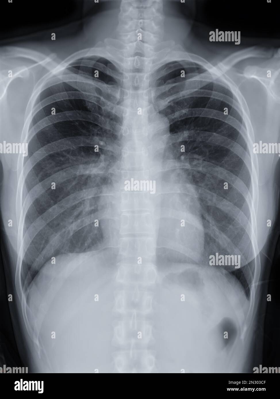 Chest xray image for screening diagnosis TB,tuberculosis and covid19