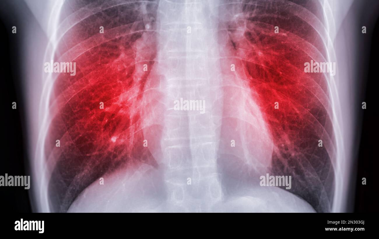 Chest xray image for screening diagnosis TB,tuberculosis and covid19