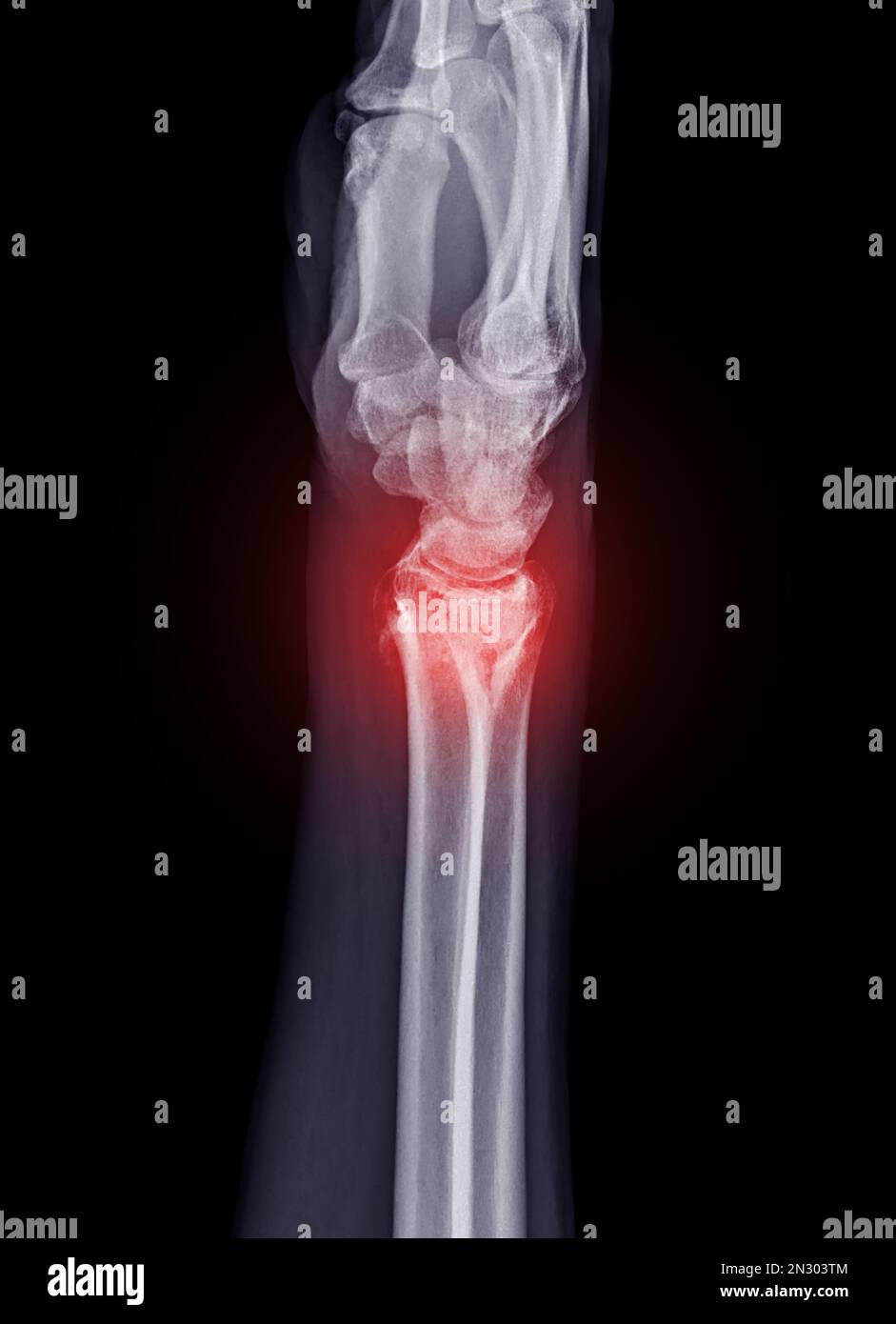 Film xray Wrist joint showing fracture of ulnar bone isolated on black