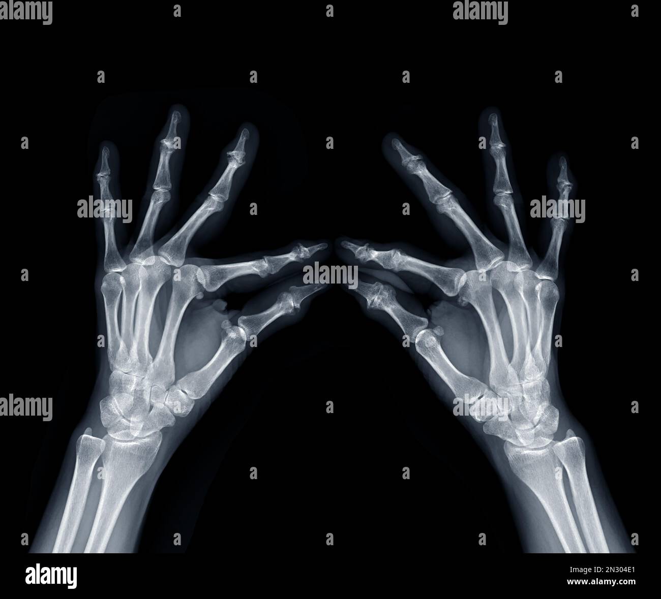 Film x-ray both hand oblique view show  human's hands isolated  on black background . Stock Photo