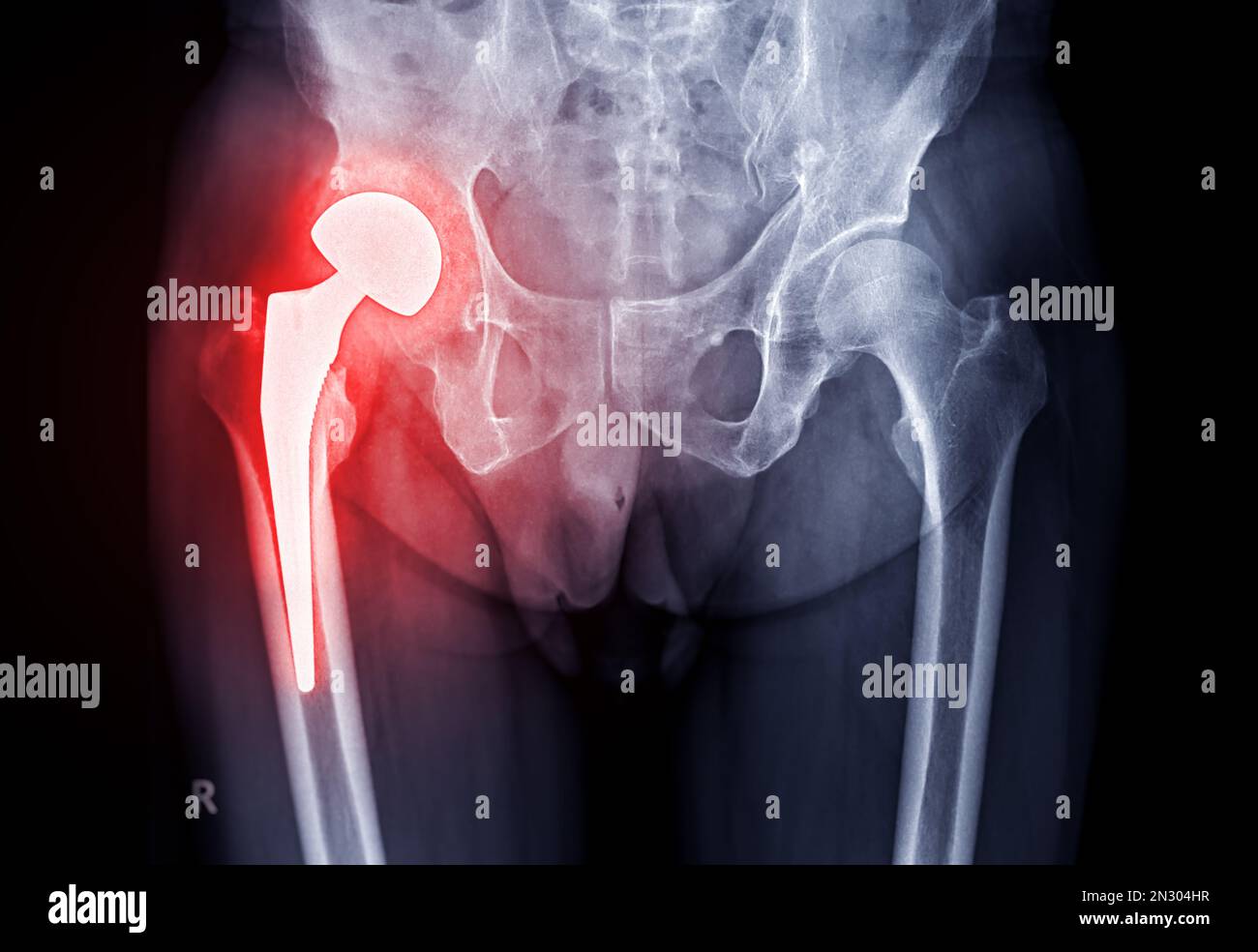 x-ray Both hip  ap view showing Right hip replacement or hip prosthesis made from titanium. Stock Photo