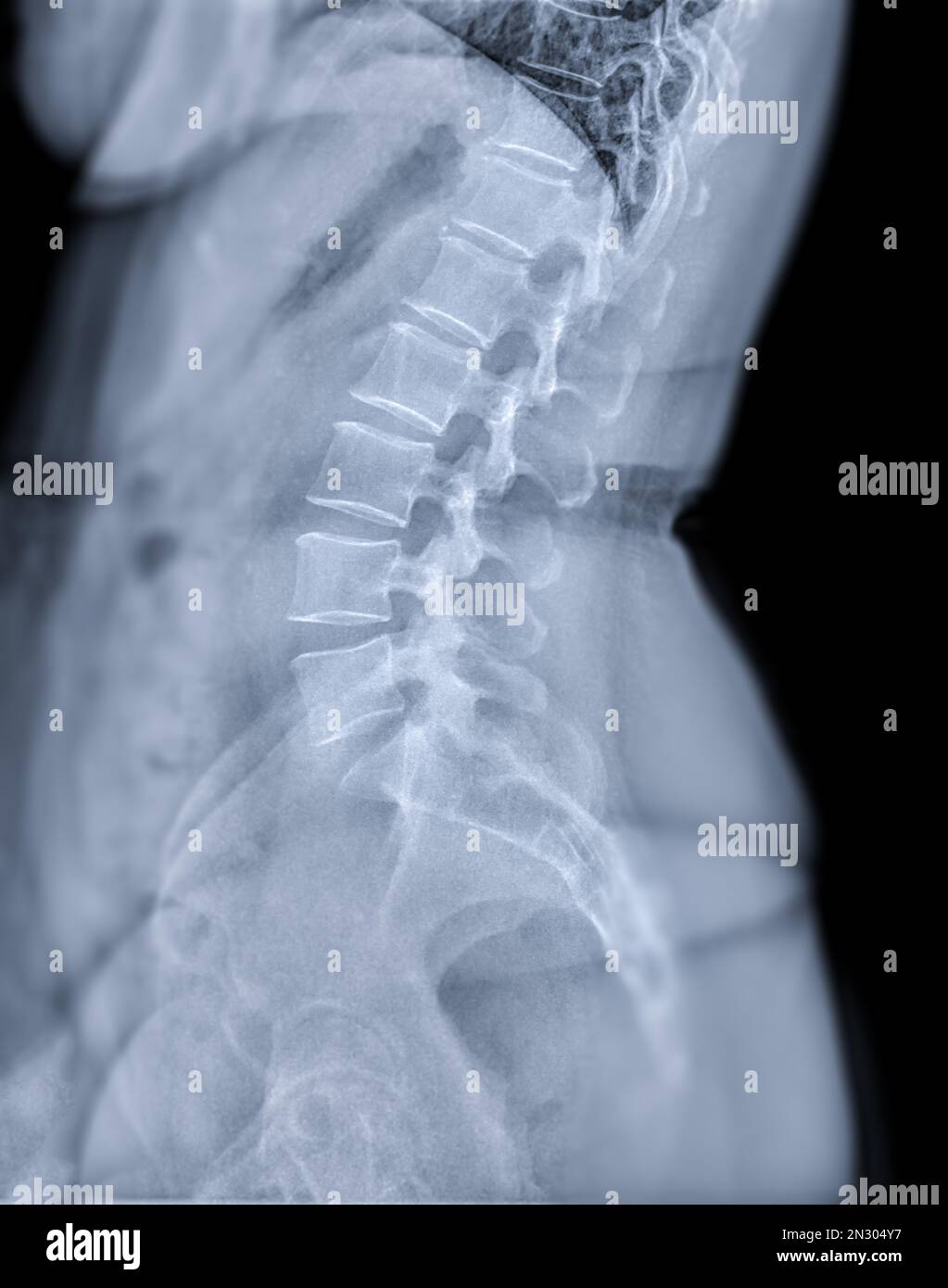 X-ray image of lumbar Spine  or L-s spine lateral view for diagnosis lower back pain. Stock Photo