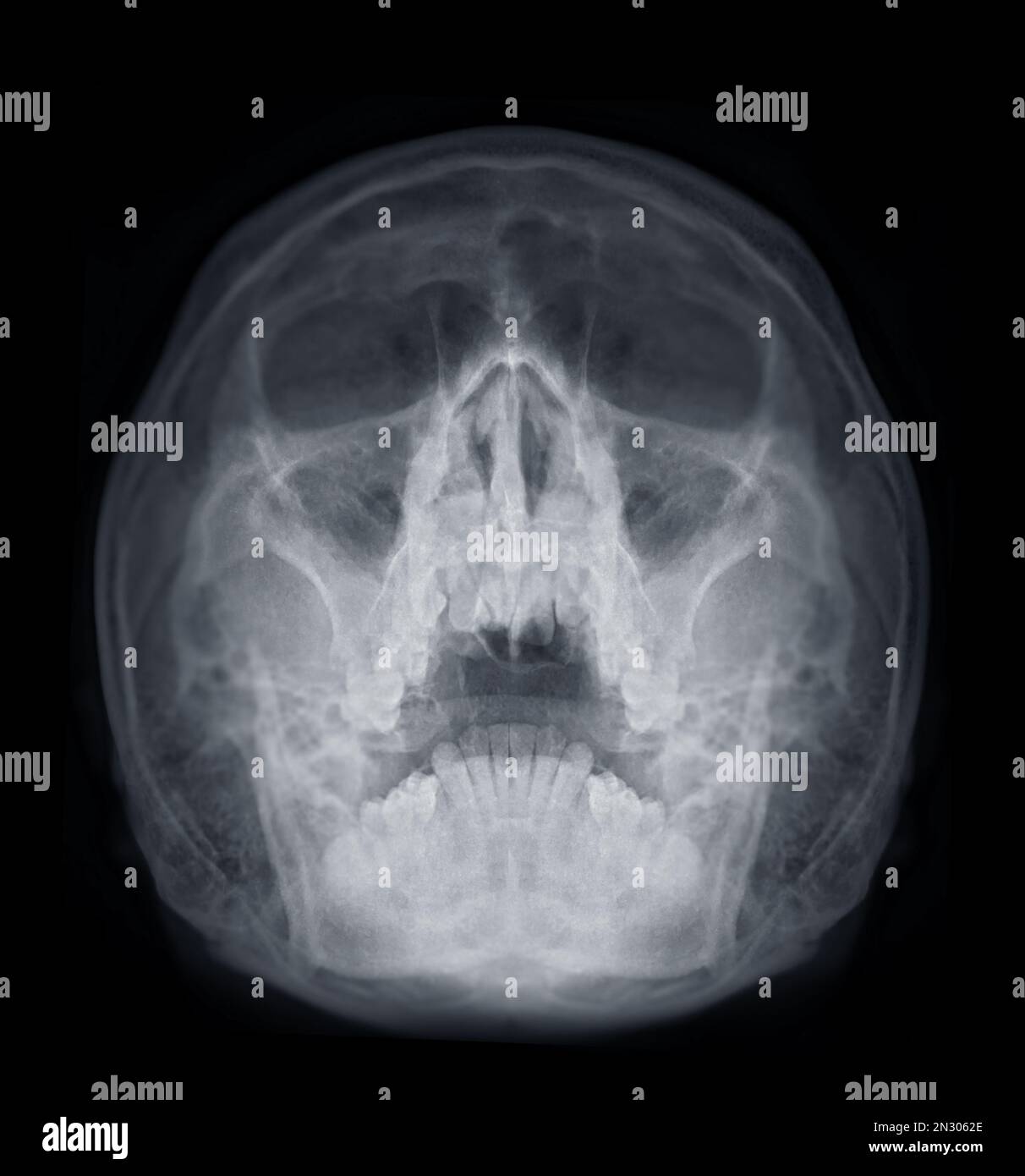 Frontal sinus cavity hires stock photography and images Alamy
