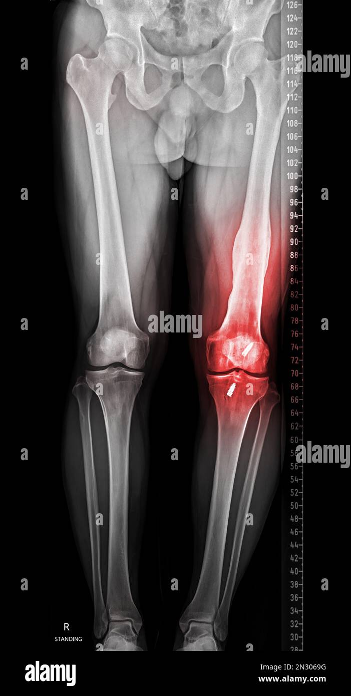 Scanogram is a Full-length standing AP radiograph of both lower extremities including the hip, knee, and ankle. Stock Photo