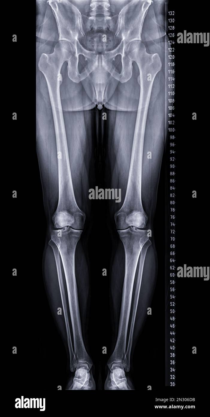 https://c8.alamy.com/comp/2N306DB/scanogram-is-a-full-length-standing-ap-radiograph-of-both-lower-extremities-including-the-hip-knee-and-ankle-2N306DB.jpg