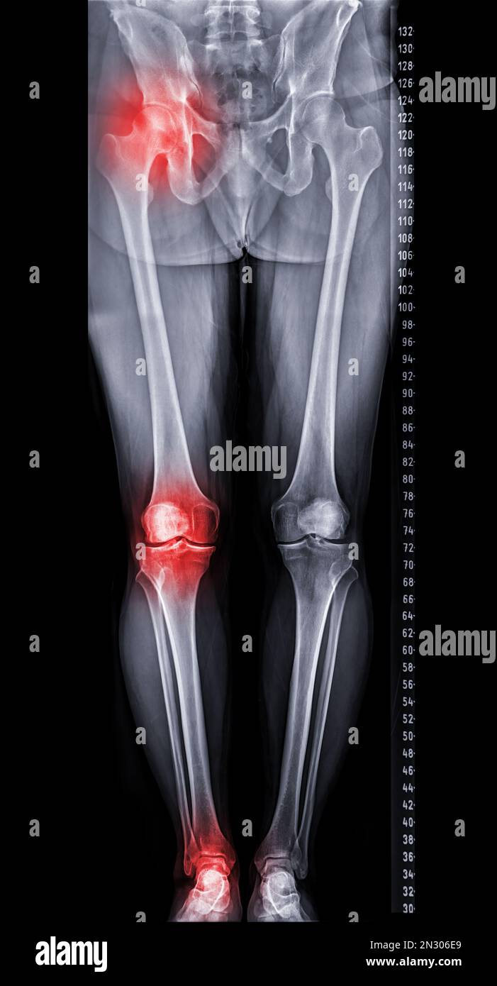 Scanogram is a Full-length standing AP radiograph of both lower extremities including the hip, knee, and ankle. Stock Photo
