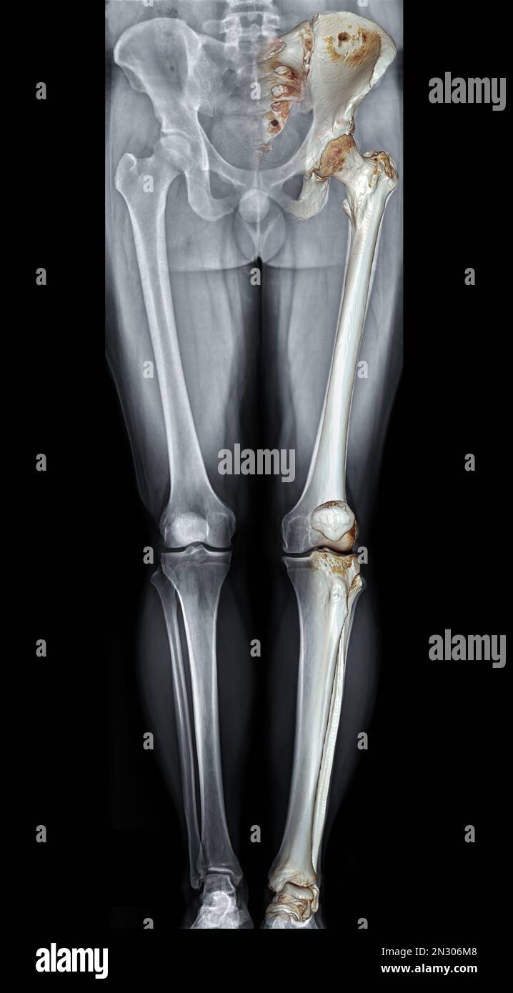 Scanogram is a Full-length standing AP radiograph of both lower extremities including the hip, knee, and ankle with 3D rendering. Stock Photo