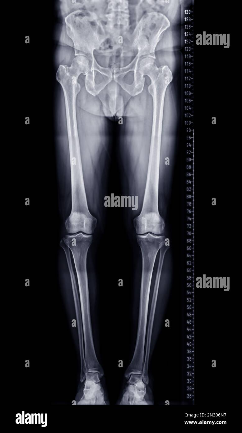 Scanogram is a Full-length standing AP radiograph of both lower ...