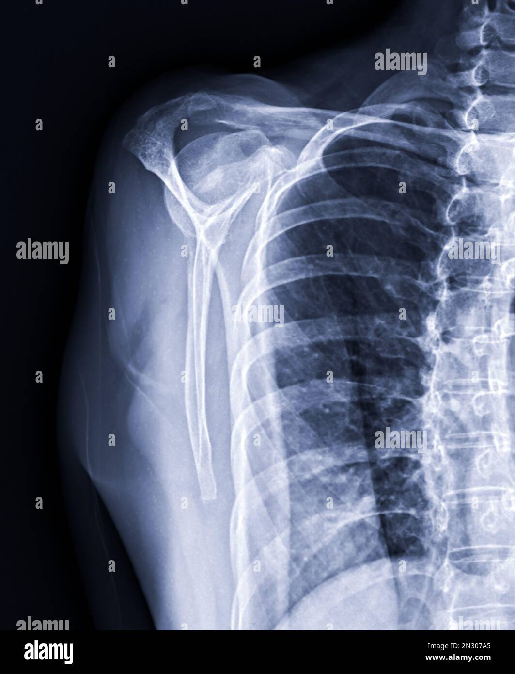 Xray Shoulder joint shoulder transcapular view for diagnosis fracture
