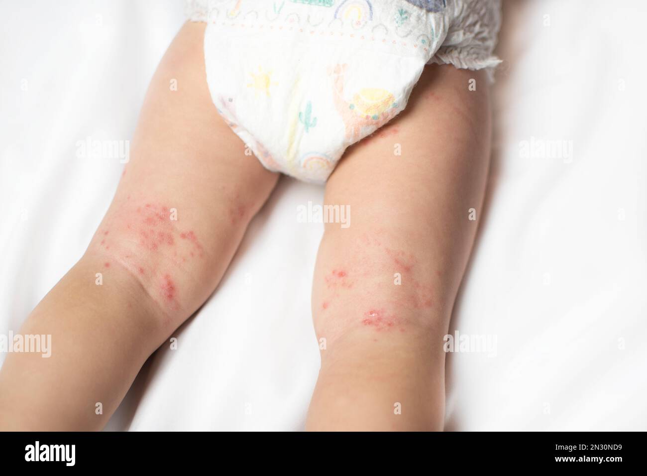 Hand, Foot, and Mouth disease rash on a baby's legs. Coxsackie virus Stock Photo
