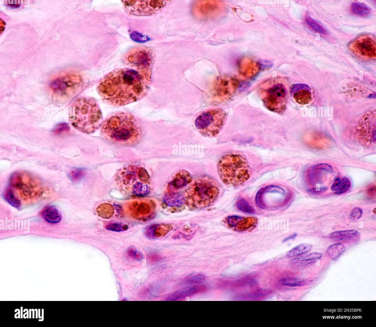 Macrophages heavily labelled with colloidal iron. Colloidal iron can be
