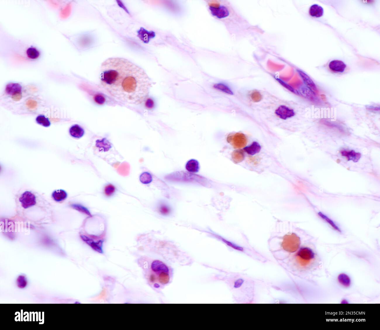Macrophages showing large brown inclusions originated by phagocytosis ...