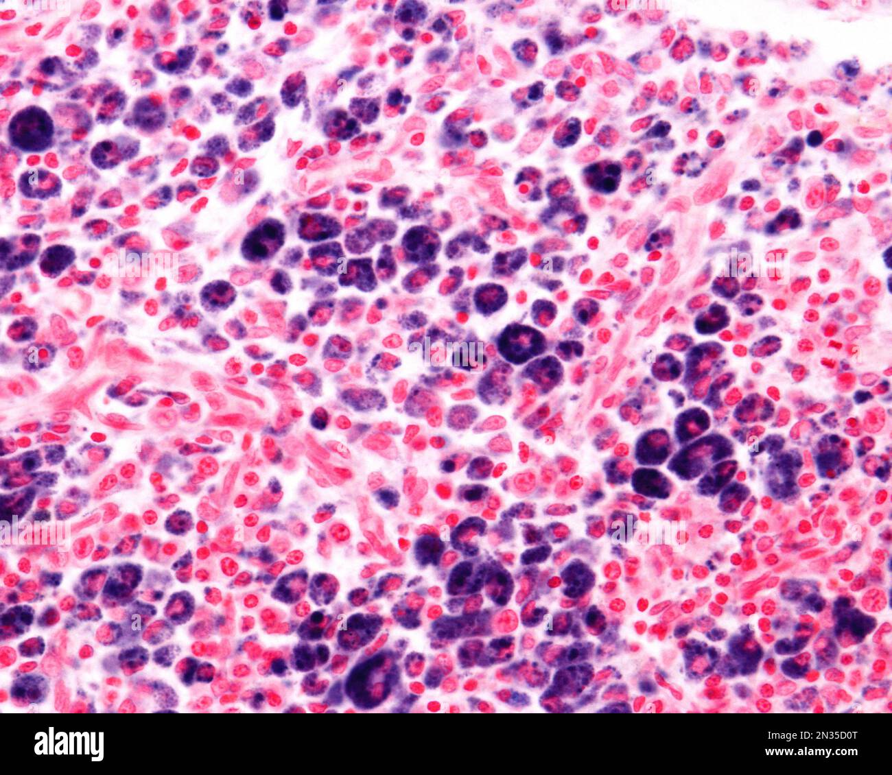 Macrophages of an inflammation zone heavily marked with Trypan blue a vital stain that can be introduced in the body. Circulating Trypan blue is phago Stock Photo