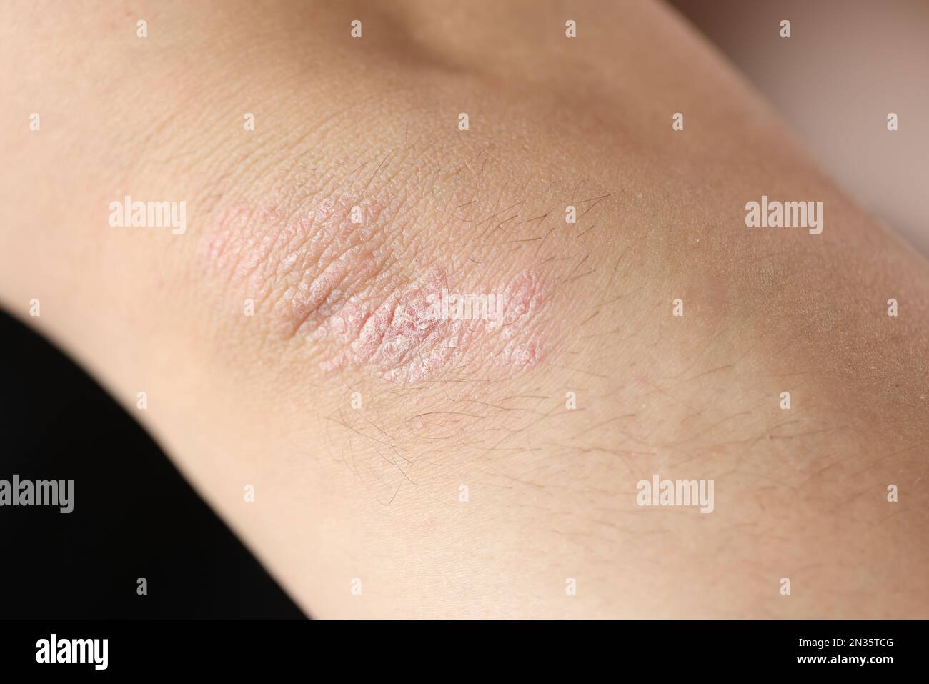 Damaged, dry itchy skin on elbow area closeup Stock Photo Alamy