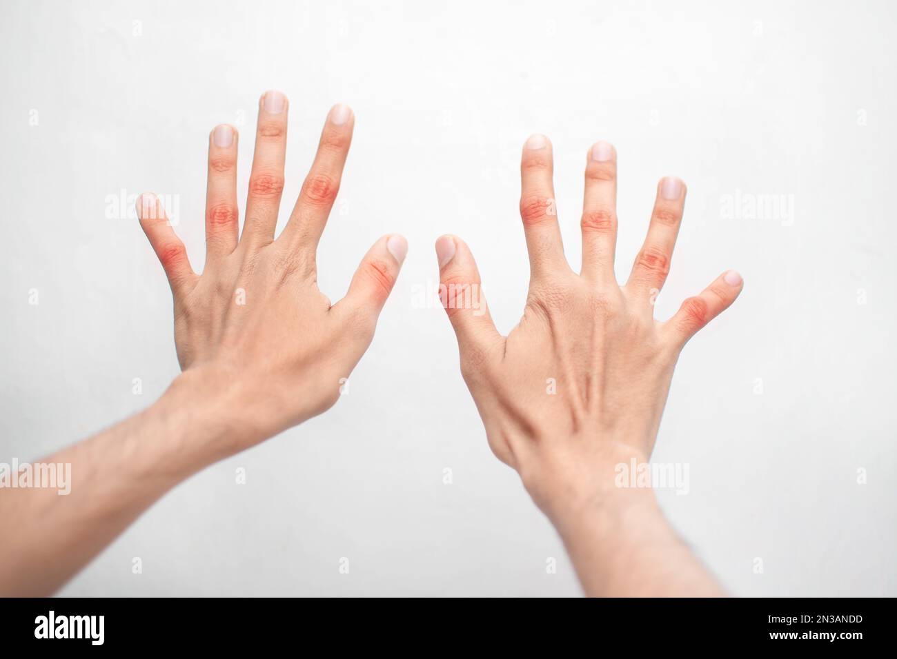 A Pair Of Hands With Burning Red Sore Knuckles From Rheumatoid