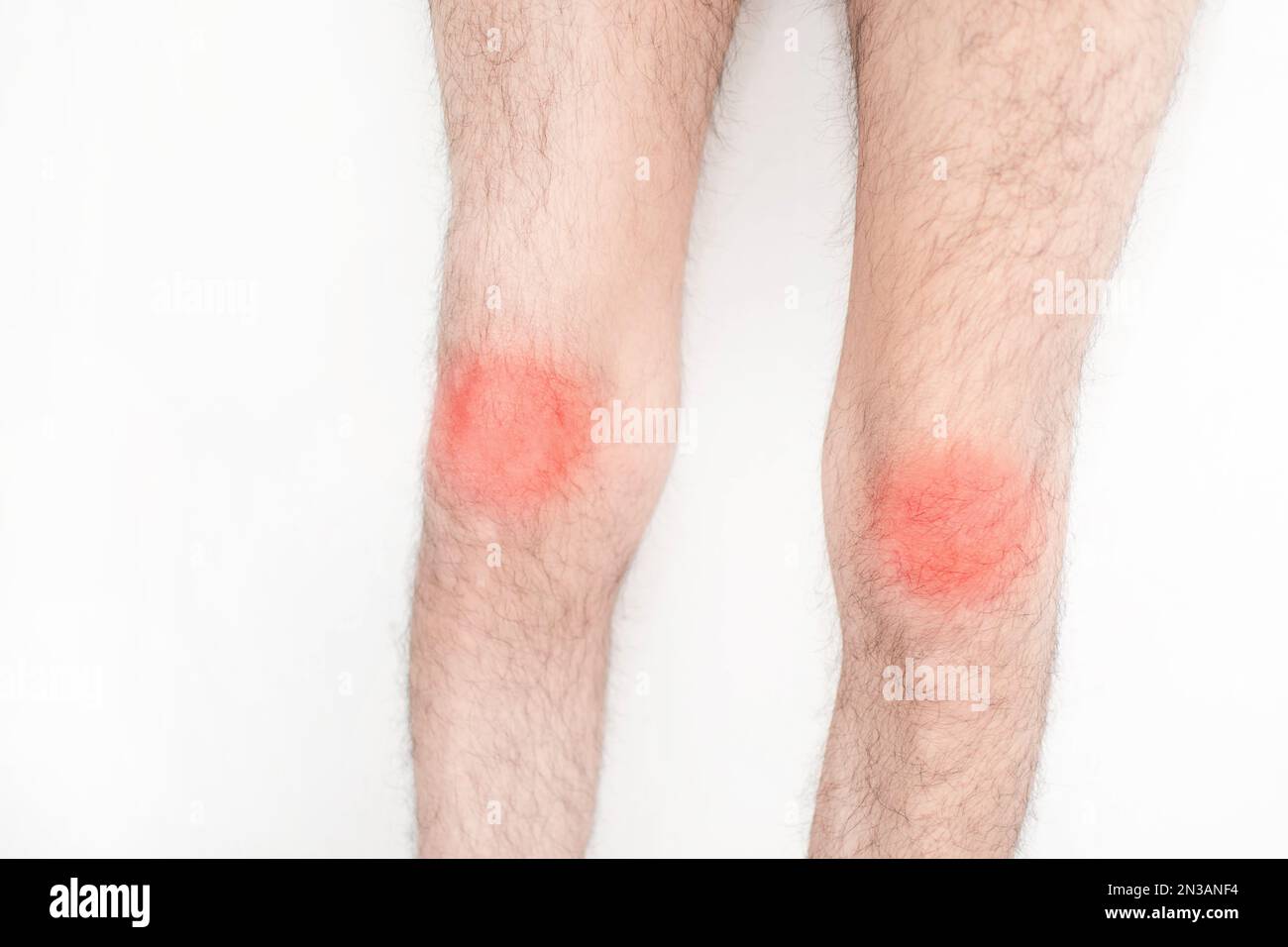 A pair of legs with burning red sore knees on a white background Stock